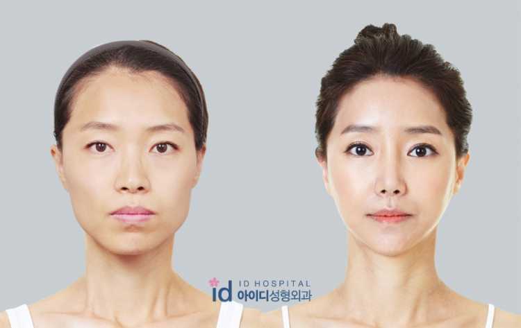 v-shaped face south korea